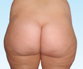 Foto před zákrokem: Liposukce  (foto 24)