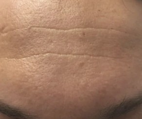 Foto před zákrokem: Frakční ablativní CO2 laser (foto 57)