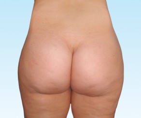 Foto po zákroku: Liposukce  (foto 24)