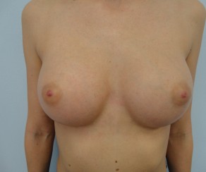 Foto po zákroku: Zvětšení prsou implantáty (foto 26)