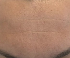 Foto po zákroku: Frakční ablativní CO2 laser (foto 57)